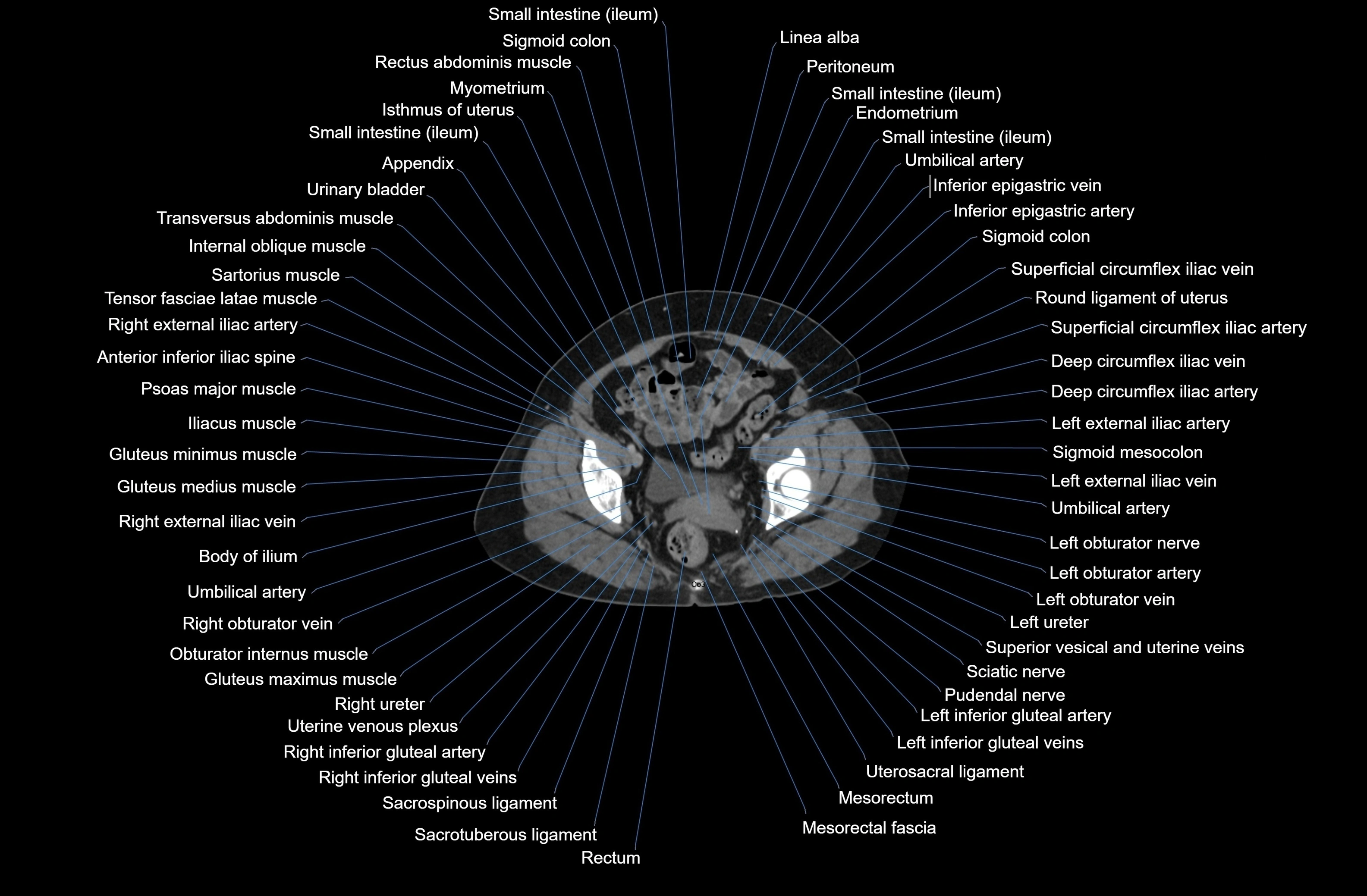 CT Abdomen axial cross sectional anatomy labelled radiology image-00086.webp